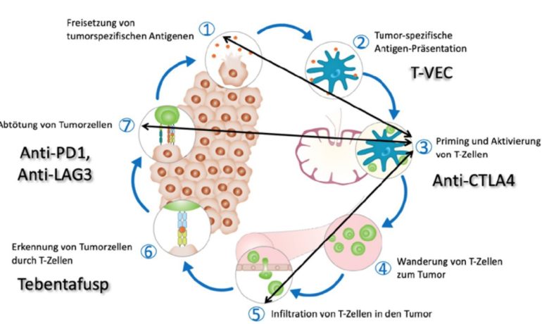 Systemische Behandlungsoptionen beim kutanen Melanom
